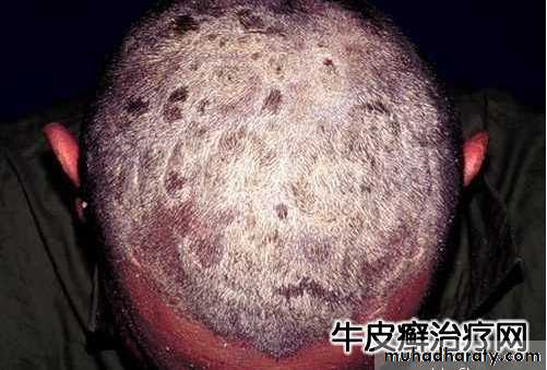psoriasis