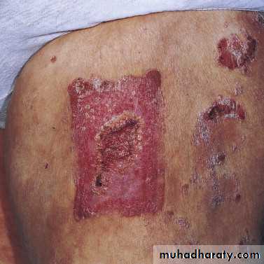 psoriasis