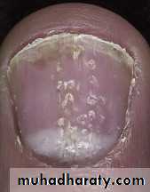 psoriasis