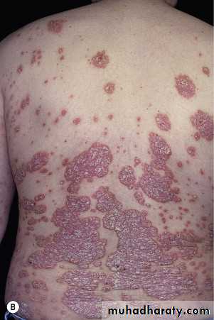 psoriasis