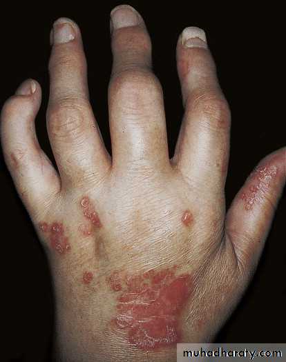 psoriasis