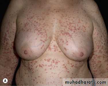 psoriasis