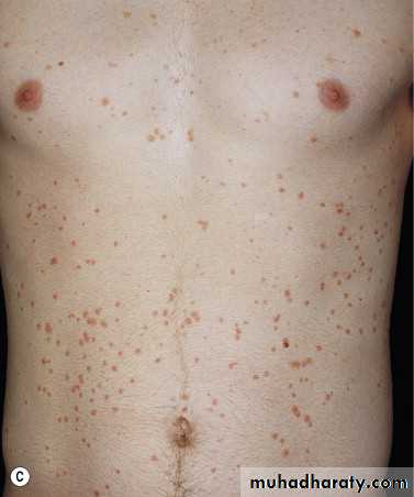 psoriasis