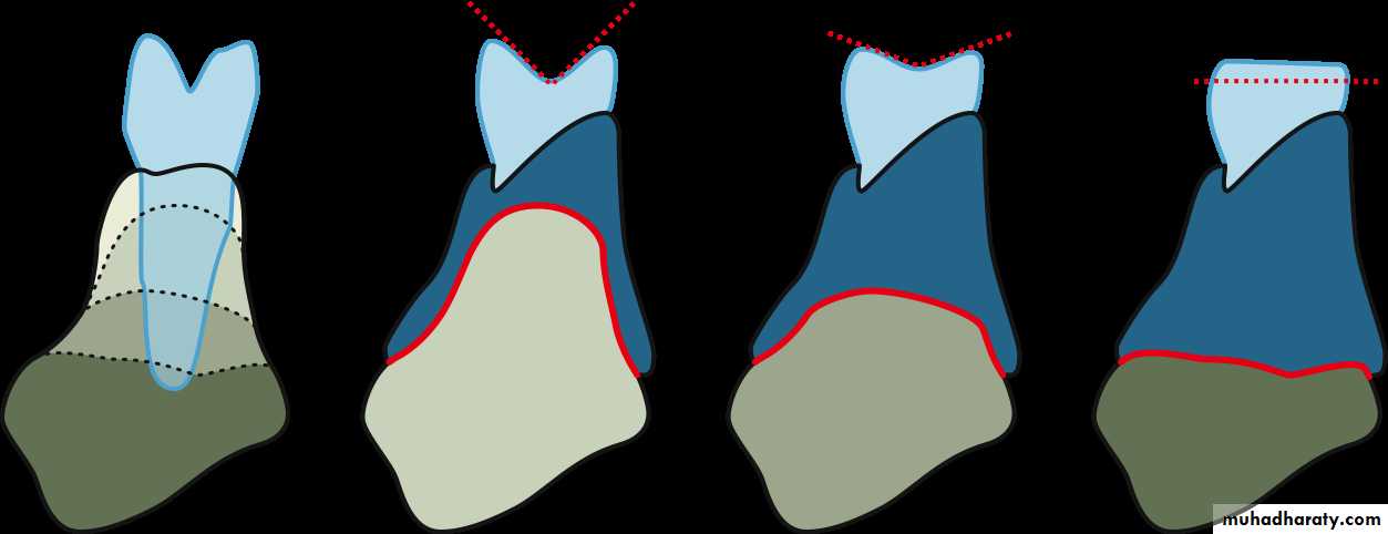 Selection of teeth