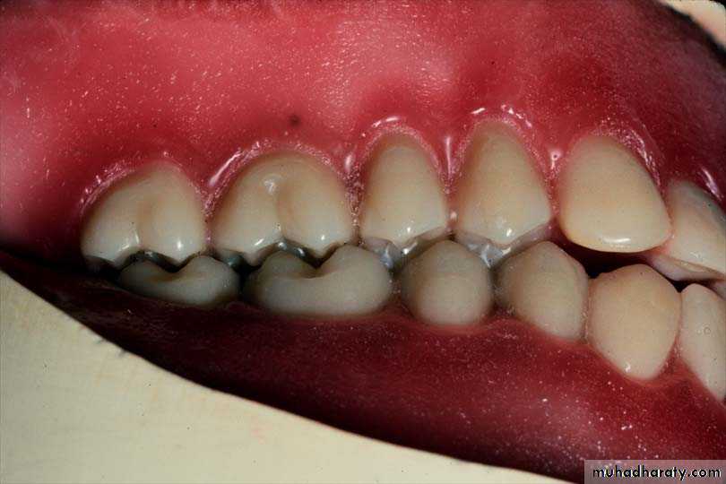 Selection of teeth