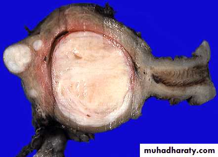 early pregnancy bleeding