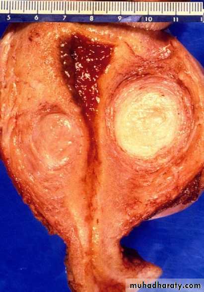 early pregnancy bleeding