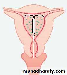 early pregnancy bleeding