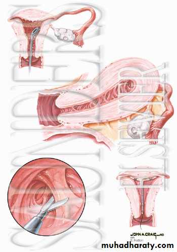 early pregnancy bleeding