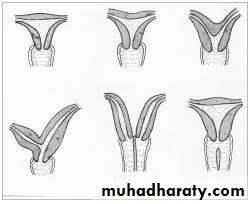 early pregnancy bleeding