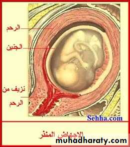 early pregnancy bleeding