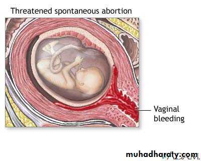 early pregnancy bleeding