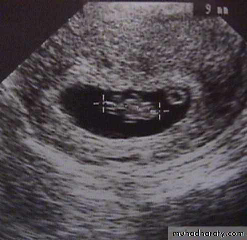 early pregnancy bleeding