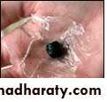 early pregnancy bleeding