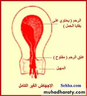early pregnancy bleeding