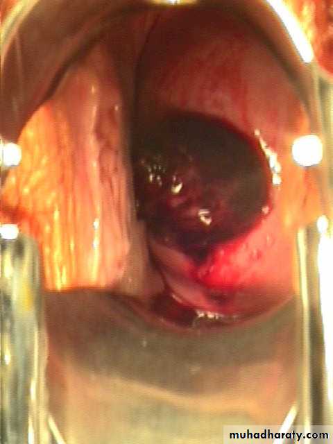 early pregnancy bleeding