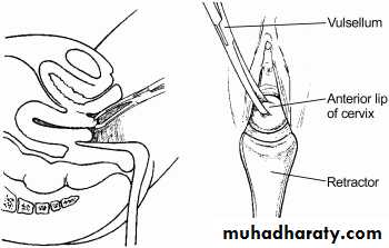 early pregnancy bleeding