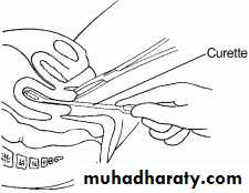 early pregnancy bleeding