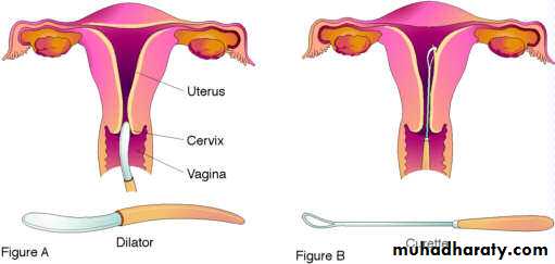 early pregnancy bleeding