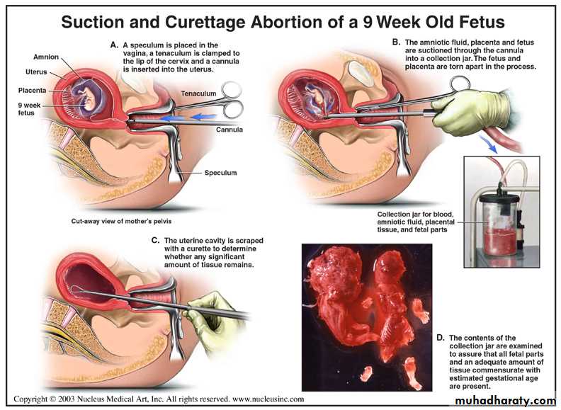 early pregnancy bleeding