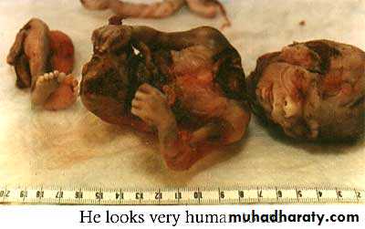 early pregnancy bleeding