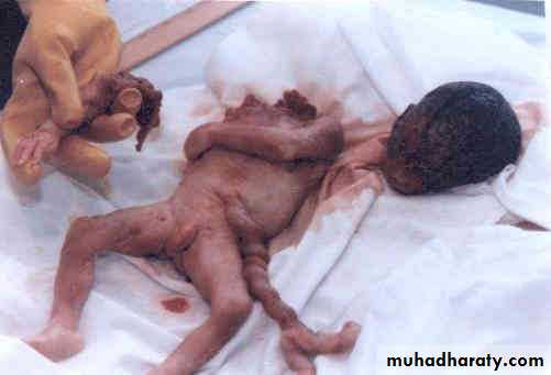 early pregnancy bleeding