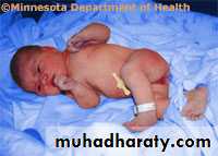 early pregnancy bleeding