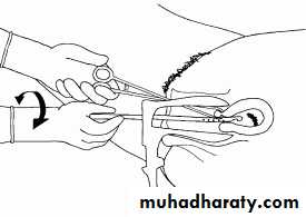 early pregnancy bleeding