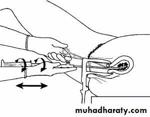 early pregnancy bleeding