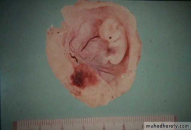 early pregnancy bleeding