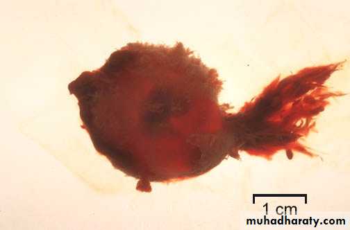 early pregnancy bleeding