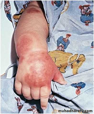 Hemolytic Uremic Syndrome