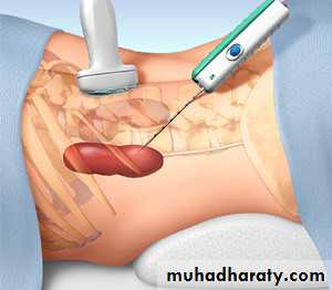 Hemolytic Uremic Syndrome