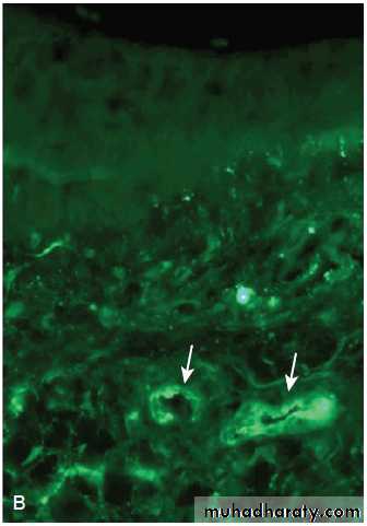 Hemolytic Uremic Syndrome