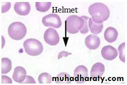 Hemolytic Uremic Syndrome