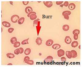 Hemolytic Uremic Syndrome