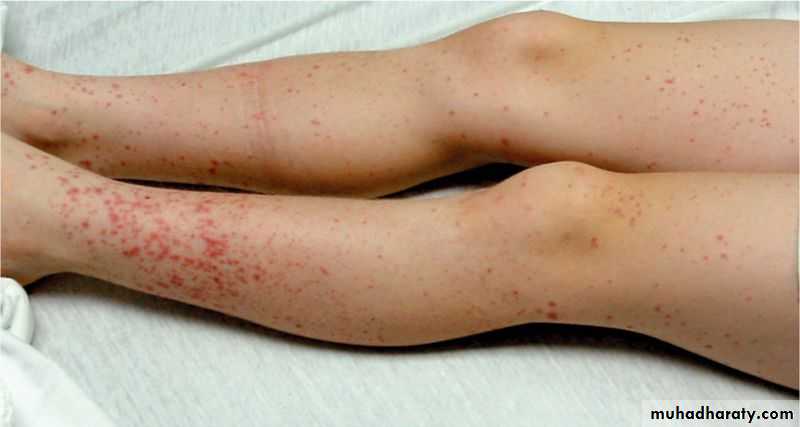 Hemolytic Uremic Syndrome