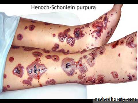 Hemolytic Uremic Syndrome