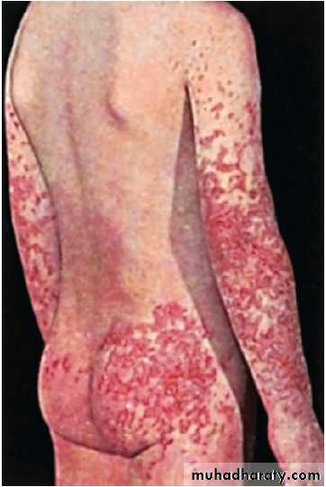 Hemolytic Uremic Syndrome