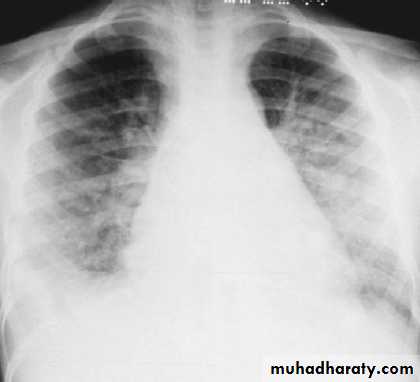 ACUTE GLOMERULONEPHRITIS
