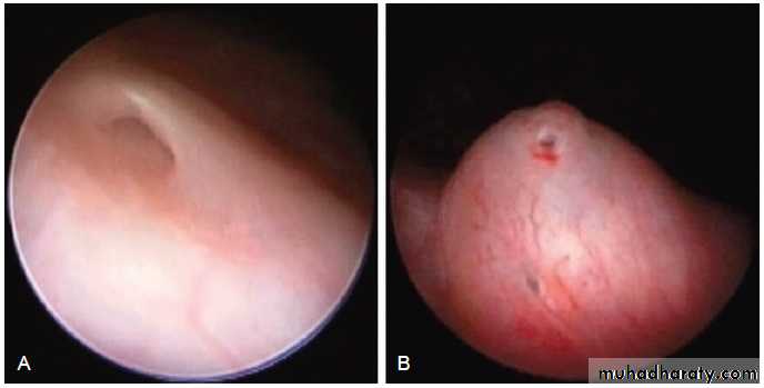 Vesicoureteral Reflux