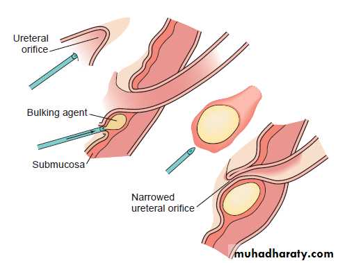 Vesicoureteral Reflux