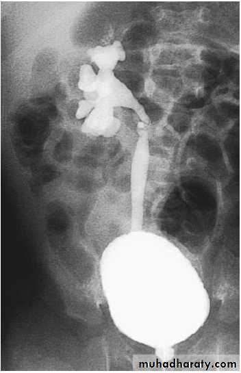 Vesicoureteral Reflux