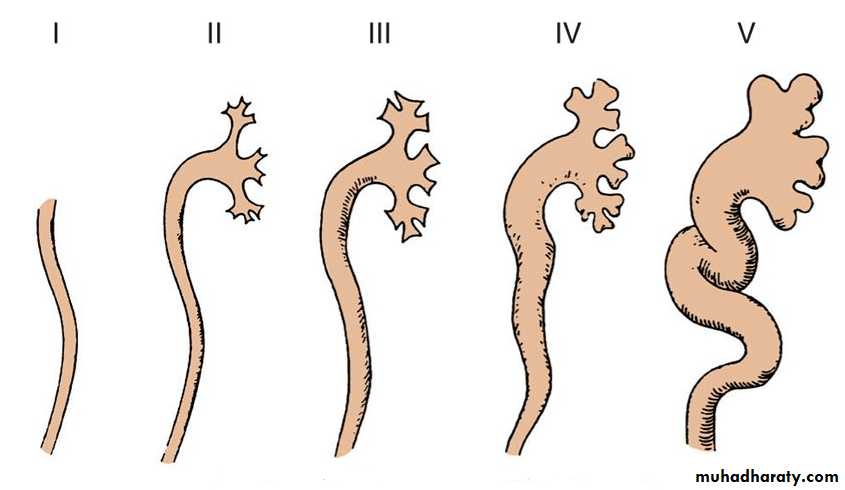 Vesicoureteral Reflux
