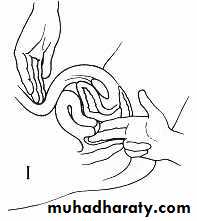 Ectopic pregnancy
