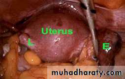 Ectopic pregnancy