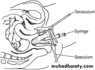 Ectopic pregnancy