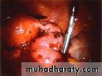 Ectopic pregnancy