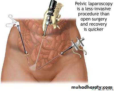Ectopic pregnancy