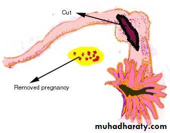 Ectopic pregnancy